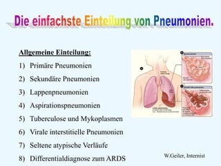 Allgemeine Einteilung:
1) Primäre Pneumonien
2) Sekundäre Pneumonien
3) Lappenpneumonien
4) Aspirationspneumonien
5) Tuberculose und Mykoplasmen
6) Virale interstitielle Pneumonien
7) Seltene atypische Verläufe
8) Differentialdiagnose zum ARDS W.Geiler, Internist
 