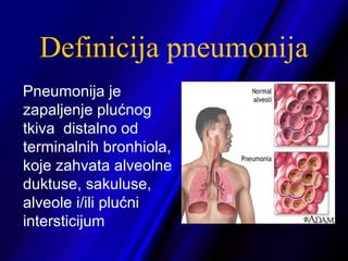 Definicija pneumonija
Pneumonija je
zapaljenje plućnog
tkiva distalno od
terminalnih bronhiola,
koje zahvata alveolne
duktuse, sakuluse,
alveole i/ili plućni
intersticijum
 