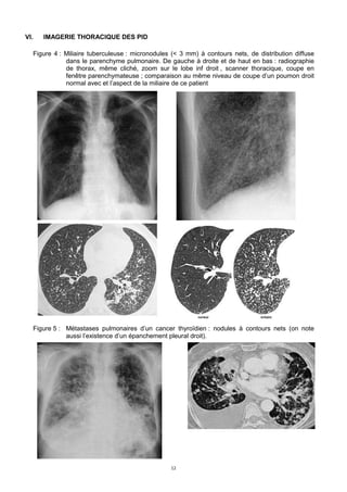 12
VI. IMAGERIE THORACIQUE DES PID
Figure 4 : Miliaire tuberculeuse : micronodules (< 3 mm) à contours nets, de distribution diffuse
dans le parenchyme pulmonaire. De gauche à droite et de haut en bas : radiographie
de thorax, même cliché, zoom sur le lobe inf droit , scanner thoracique, coupe en
fenêtre parenchymateuse ; comparaison au même niveau de coupe d’un poumon droit
normal avec et l’aspect de la miliaire de ce patient
Figure 5 : Métastases pulmonaires d’un cancer thyroïdien : nodules à contours nets (on note
aussi l’existence d’un épanchement pleural droit).
 