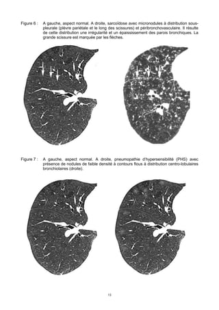 13
Figure 6 : A gauche, aspect normal. A droite, sarcoïdose avec micronodules à distribution sous-
pleurale (plèvre pariétale et le long des scissures) et péribronchovasculaire. Il résulte
de cette distribution une irrégularité et un épaississement des parois bronchiques. La
grande scissure est marquée par les flèches.
Figure 7 : A gauche, aspect normal. A droite, pneumopathie d’hypersensibilité (PHS) avec
présence de nodules de faible densité à contours flous à distribution centro-lobulaires
bronchiolaires (droite).
 