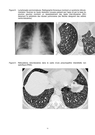 14
Figure 8 : Lymphangite carcinomateuse. Radiographie thoracique montrant un syndrome réticulo-
nodulaire. Scanner en haute résolution (coupes passant par l’apex et par la base du
poumon gauche) montrant un épaississement des septa inter-lobulaires (SIL)
dessinant la périphérie des lobules pulmonaires (les flèches désignent des artères
centro-lobulaires).
Figure 9 : Réticulations intra-lobulaires dans le cadre d’une pneumopathie interstitielle non
spécifique (PINS).
 
