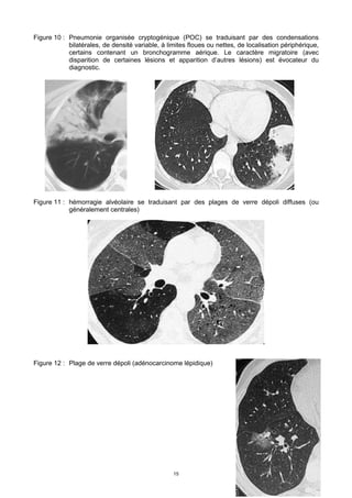 15
Figure 10 : Pneumonie organisée cryptogénique (POC) se traduisant par des condensations
bilatérales, de densité variable, à limites floues ou nettes, de localisation périphérique,
certains contenant un bronchogramme aérique. Le caractère migratoire (avec
disparition de certaines lésions et apparition d’autres lésions) est évocateur du
diagnostic.
Figure 11 : hémorragie alvéolaire se traduisant par des plages de verre dépoli diffuses (ou
généralement centrales)
Figure 12 : Plage de verre dépoli (adénocarcinome lépidique)
 