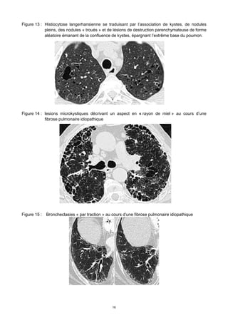 16
Figure 13 : Histiocytose langerhansienne se traduisant par l’association de kystes, de nodules
pleins, des nodules « troués » et de lésions de destruction parenchymateuse de forme
aléatoire émanant de la confluence de kystes, épargnant l’extrême base du poumon.
Figure 14 : lesions microkystiques décrivant un aspect en « rayon de miel » au cours d’une
fibrose pulmonaire idiopathique
Figure 15 : Bronchectasies « par traction » au cours d’une fibrose pulmonaire idiopathique
 