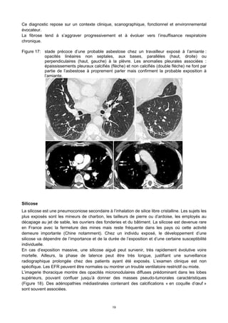 19
Ce diagnostic repose sur un contexte clinique, scanographique, fonctionnel et environnemental
évocateur.
La fibrose tend à s’aggraver progressivement et à évoluer vers l’insuffisance respiratoire
chronique.
Figure 17: stade précoce d’une probable asbestose chez un travailleur exposé à l’amiante :
opacités linéaires non septales, aux bases, parallèles (haut, droite) ou
perpendiculaires (haut, gauche) à la plèvre. Les anomalies pleurales associées :
épaississements pleuraux calcifiés (flèche) et non calcifiés (double flèche) ne font par
partie de l’asbestose à proprement parler mais confirment la probable exposition à
l’amiante.
Silicose
La silicose est une pneumoconiose secondaire à l’inhalation de silice libre cristalline. Les sujets les
plus exposés sont les mineurs de charbon, les tailleurs de pierre ou d’ardoise, les employés au
décapage au jet de sable, les ouvriers des fonderies et du bâtiment. La silicose est devenue rare
en France avec la fermeture des mines mais reste fréquente dans les pays où cette activité
demeure importante (Chine notamment). Chez un individu exposé, le développement d’une
silicose va dépendre de l’importance et de la durée de l’exposition et d’une certaine susceptibilité
individuelle.
En cas d’exposition massive, une silicose aiguë peut survenir, très rapidement évolutive voire
mortelle. Ailleurs, la phase de latence peut être très longue, justifiant une surveillance
radiographique prolongée chez des patients ayant été exposés. L’examen clinique est non
spécifique. Les EFR peuvent être normales ou montrer un trouble ventilatoire restrictif ou mixte.
L’imagerie thoracique montre des opacités micronodulaires diffuses prédominant dans les lobes
supérieurs, pouvant confluer jusqu’à donner des masses pseudo-tumorales caractéristiques
(Figure 18). Des adénopathies médiastinales contenant des calcifications « en coquille d’œuf »
sont souvent associées.
 