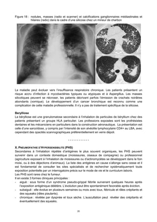 20
Figure 18 : nodules, masses (radio et scanner) et calcifications ganglionnaires médiastinales et
hilaires (radio) dans le cadre d’une silicose chez un mineur de charbon
La maladie peut évoluer vers l’insuffisance respiratoire chronique. Les patients présentent un
risque accru d’infection à mycobactéries typiques ou atypiques et à Aspergillus. Les masses
silicotiques peuvent se nécroser, les patients décrivant parfois l’émission de crachats noirâtres
abondants (vomique). Le développement d’un cancer bronchique est reconnu comme une
complication de cette maladie professionnelle. Il n’y a pas de traitement spécifique de la silicose.
Berylliose
La bérylliose est une granulomatose secondaire à l’inhalation de particules de béryllium chez des
patients présentant un groupe HLA particulier. Les professions exposées sont les prothésistes
dentaires et les mécaniciens en particuliers dans la construction aéronautique. La présentation est
celle d’une sarcoïdose, y compris par l’intensité de son alvéolite lymphocytaire CD4+ au LBA, avec
cependant des opacités scannographiques préférentiellement en verre dépoli.
- - - - - - - - - - - -
X. PNEUMOPATHIE D’HYPERSENSIBILITE (PHS)
Secondaires à l’inhalation répétée d’antigènes le plus souvent organiques, les PHS peuvent
survenir dans un contexte domestique (moisissures, oiseaux de compagnie) ou professionnel
(agriculture exposant à l’inhalation de moisissures ou d’actinomycètes se développant dans le foin
moisi, ou à des déjections d’animaux). La liste des antigènes en cause s’allonge sans cesse et il
est fondamental de consulter les sites spécialisés et de rechercher systématiquement toute
exposition potentielle par un interrogatoire précis sur le mode de vie et le curriculum laboris.
Les PHS sont rares chez le fumeur.
Il en existe 3 formes cliniques principales :
- aiguë : sous forme d’un syndrome pseudo-grippal fébrile survenant quelques heures après
l’exposition antigénique délétère. L’évolution peut être spontanément favorable après éviction.
- subaiguë : elle évolue en plusieurs semaines ou mois avec toux, fébricule et râles crépitants et
des squeaks (râles piaulants).
- chronique : révélée par dyspnée et toux sèche. L’auscultation peut révéler des crépitants et
éventuellement des squeaks.
 