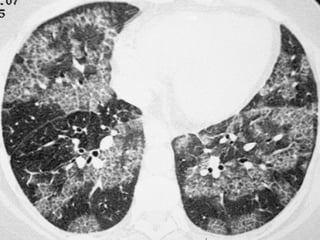  Pneumonia lipoídica
 