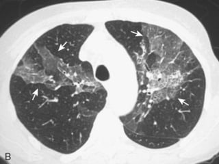  Pneumonia eosinofílica aguda
 