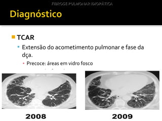  TCAR
 Extensão do acometimento pulmonar e fase da
dça.
▪ Precoce: áreas em vidro fosco
▪ Avançada: faveolamento
FIBROSE PULMONAR IDIOPÁTICAFIBROSE PULMONAR IDIOPÁTICA
 