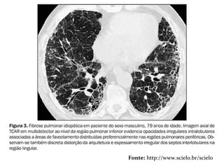 FIBROSE PULMONAR IDIOPÁTICAFIBROSE PULMONAR IDIOPÁTICA
Fonte: http://www.scielo.br/scielo
 