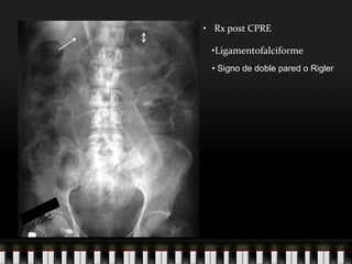 Pneumoperitoneo_2011.ppt