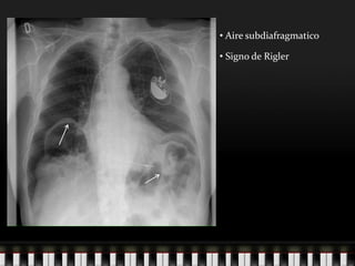 Sdinal De Rigler Pneumoperitoneo_2011.ppt