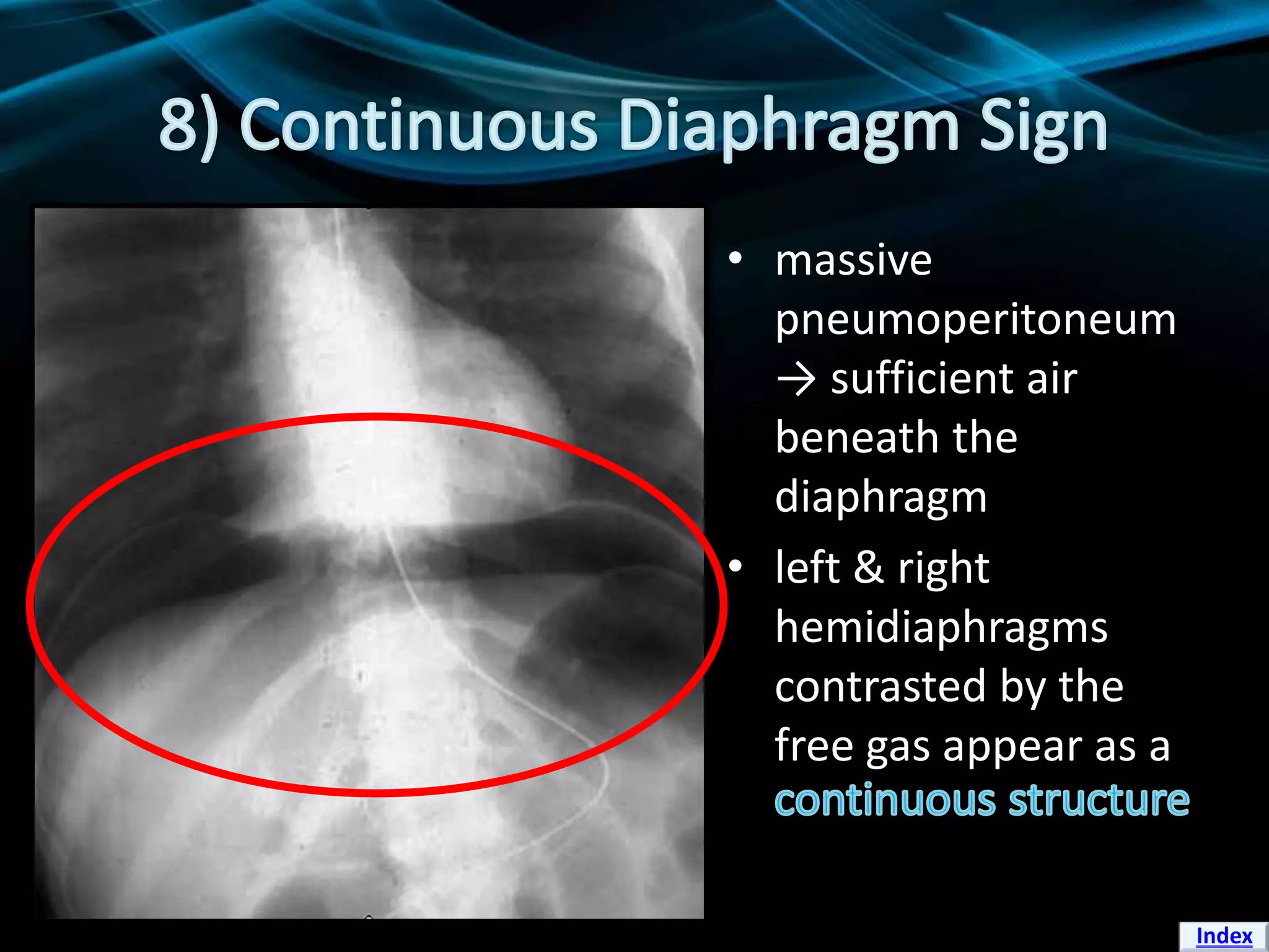 Signs Of Pneumoperitoneum On Plain Film PPTX Signs Of Pneumoperitoneum On Plain Film PPTX