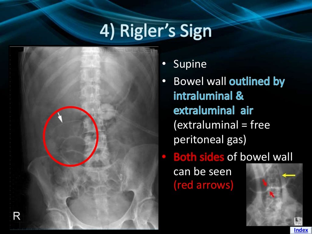 Signs of Pneumoperitoneum on Plain Film