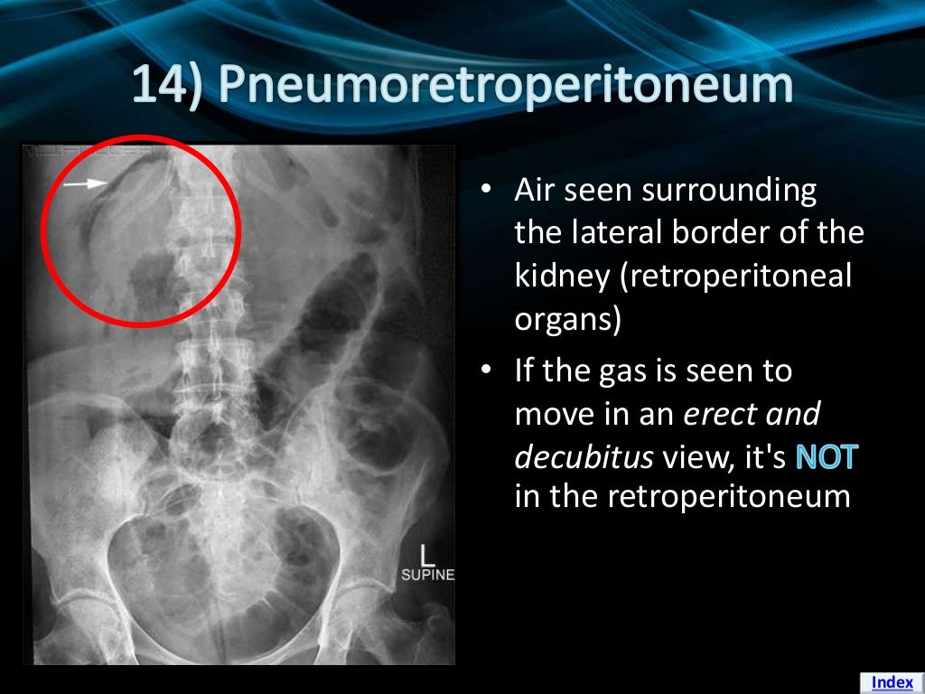 Signs of Pneumoperitoneum on Plain Film