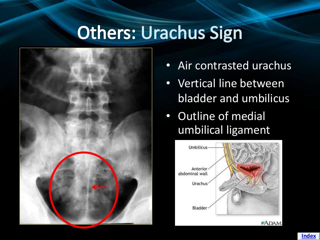 Pneumoperitoneum Signs