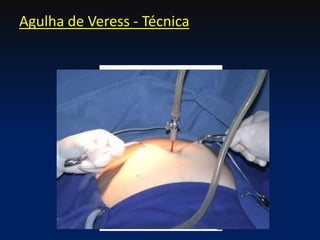 Agulha de Veress - Técnica
 