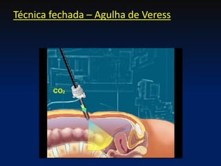 Técnica fechada – Agulha de Veress
 