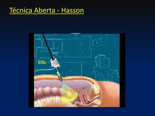 Técnica Aberta - Hasson
 