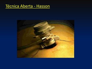 Técnica Aberta - Hasson
 