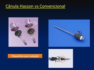 Dispositivo para vedação
Cânula Hasson vs Convencional
 