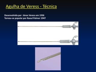 Agulha de Veress - Técnica
Desenvolvida por János Veress em 1936
Tornou-se popular por Raoul Palmer 1947
 