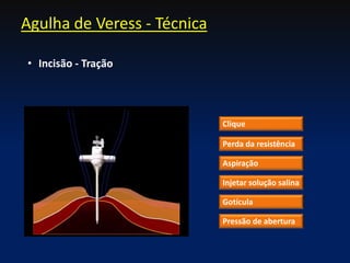 Agulha de Veress - Técnica
Clique
Perda da resistência
Aspiração
Injetar solução salina
Gotícula
Pressão de abertura
• Incisão - Tração
 