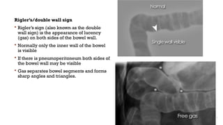 Comprehensive Overview of Pneumoperitoneum: Causes, Diagnosis, and ...