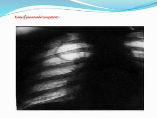 Pneumosclerosis Pneumosclerosis | PPTX