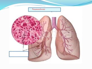 Pneumosclerosis Pneumosclerosis | PPTX