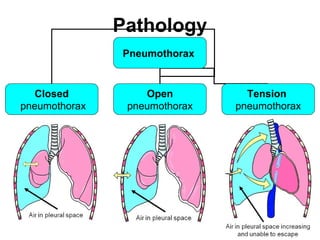 Pathology
Pneumothorax
Closed
pneumothorax
Open
pneumothorax
Tension
pneumothorax
 