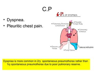 C.P
Dyspnea is more common in 2ry spontaneous pneumothorax rather than
1ry spontaneous pneumothorax due to poor pulmonary reserve.
• Dyspnea.
• Pleuritic chest pain.
 