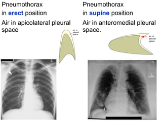 Pneumothorax
in erect position
Pneumothorax
in supine position
Air in apicolateral pleural
space
Air in anteromedial pleural
space.
 