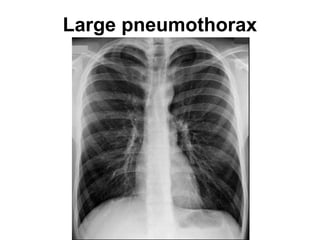 Large pneumothorax
 