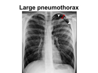 Large pneumothorax
 