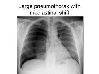 Large pneumothorax with
mediastinal shift
 