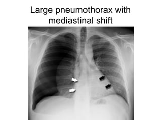 Large pneumothorax with
mediastinal shift
 