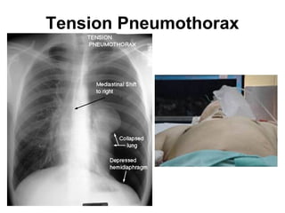Tension Pneumothorax
 