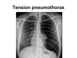 Tension pneumothorax
 