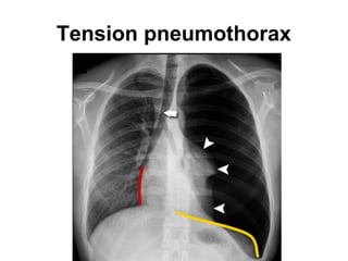 Tension pneumothorax
 
