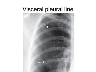 Visceral pleural line
 