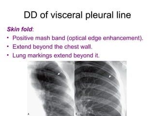 DD of visceral pleural line
Skin fold:
• Positive mash band (optical edge enhancement).
• Extend beyond the chest wall.
• Lung markings extend beyond it.
 