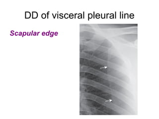 DD of visceral pleural line
Scapular edge
 