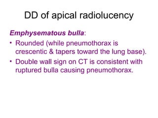 DD of apical radiolucency
Emphysematous bulla:
• Rounded (while pneumothorax is
crescentic & tapers toward the lung base).
• Double wall sign on CT is consistent with
ruptured bulla causing pneumothorax.
 