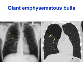 Giant emphysematous bulla
 