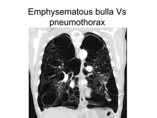 Emphysematous bulla Vs
pneumothorax
 