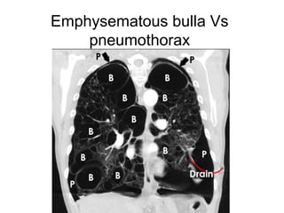 Emphysematous bulla Vs
pneumothorax
 