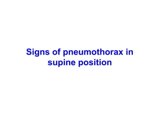 Signs of pneumothorax in
supine position
 