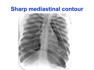 Sharp mediastinal contour
 