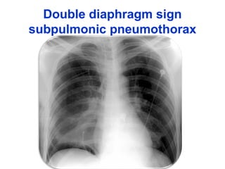 Double diaphragm sign
subpulmonic pneumothorax
 