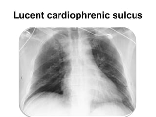 Lucent cardiophrenic sulcus
 